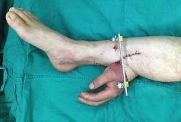 You Won’t Believe How This Extraordinary Operation Saved a Man’s Hand