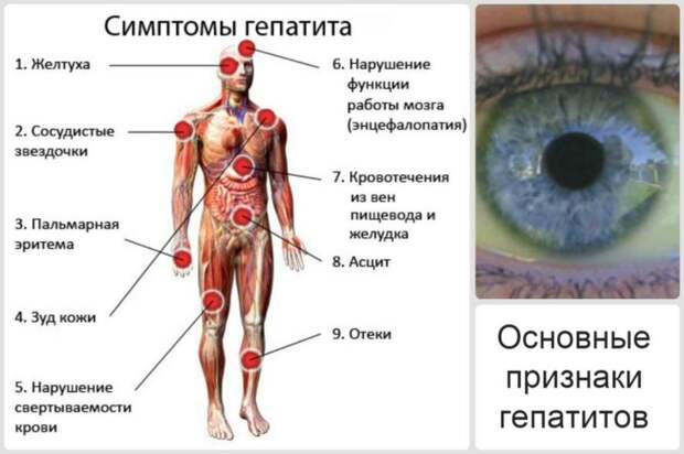 Страшный гепатит - как народными методами люди себе лечение улучшали, здоровье поправляли на удивление врачей!