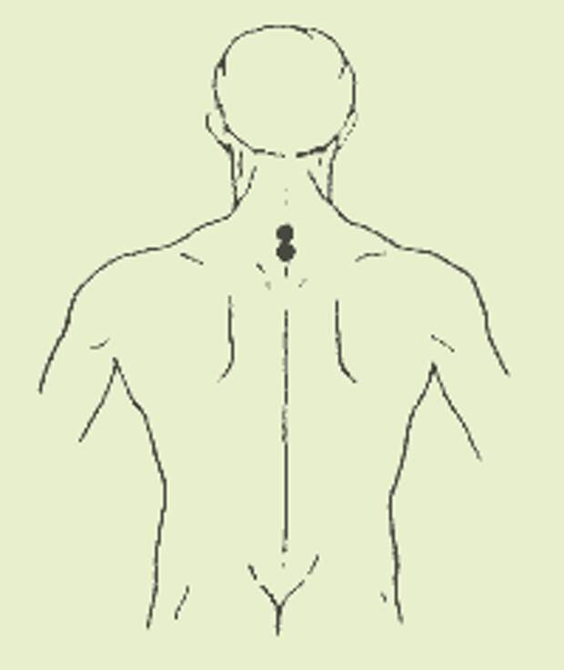 Точки для аппликации перцового пластыря при остеохондрозе шейно-грудного отдела позвоночника