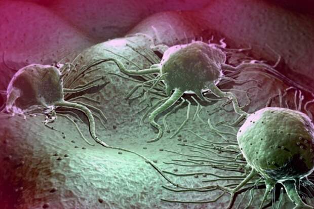 Рак живой организм. Метастазы под микроскопом.