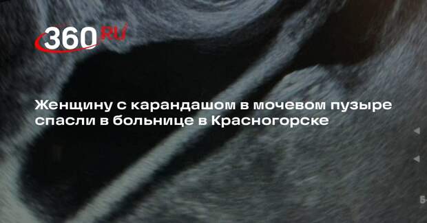 Женщину с карандашом в мочевом пузыре спасли в больнице в Красногорске
