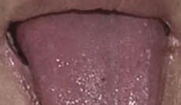 Что расскажет язык о вашем здоровье