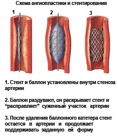 Как угробить и как спасти больного с инфарктом?