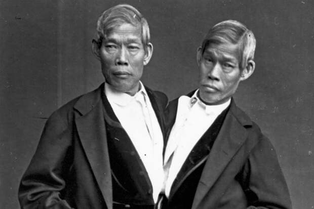 10 удивительных историй самых известных сиамских близнецов близнецы, жизнь, сиамские близнецы