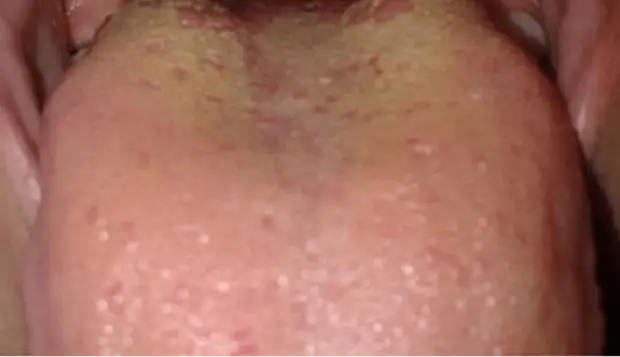 Что расскажет язык о вашем здоровье