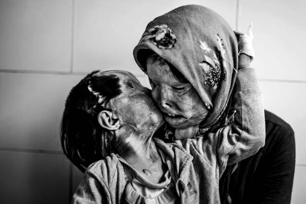 Женщина обнимает свою трехлетнюю дочь. Обе подверглись нападению их мужа и отца с банкой кислоты.