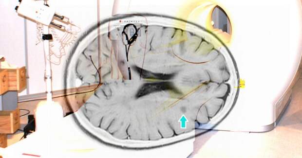 Пятилетняя терапия ублитуксимабом резко снижает рецидивы при рассеянном склерозе
