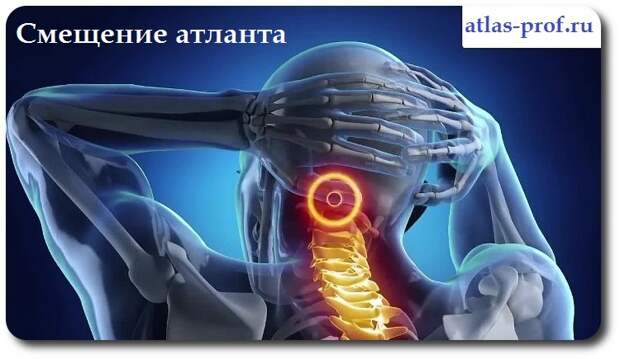 смещение позвонка аталанта
