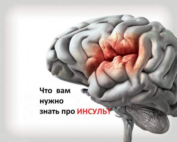 Инсульт головного мозга: факты, которые вы должны знать