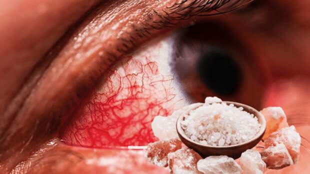 Глазная инфекция и очищение соленой водой: как сделать солевой раствор и помочь глазам