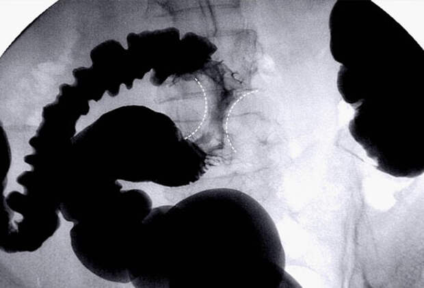 Рентгеноскопия кишечника