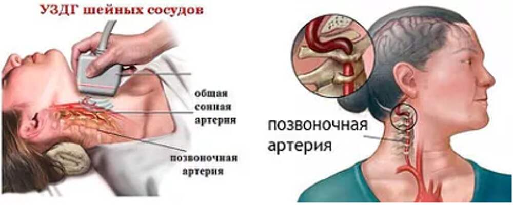 Гипертония шейного отдела