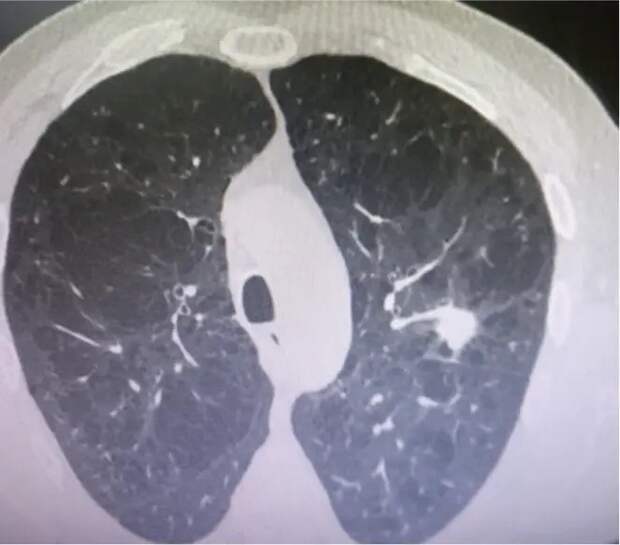 В рязанском онкодиспансере удалили опухоль, вросшую в сосуд легкого