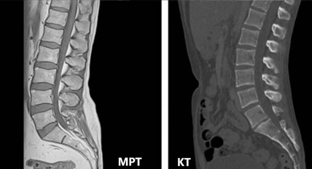 МРТ пояснично-крестцового отдела