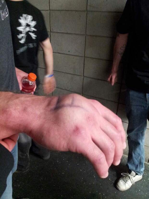 20. Опухшая рука боксера после того, как он нанес нокаутирующий удар люди, мир, фотоподборка
