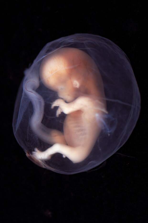 6. В Швеции разрешено прерывание беременности по причине нежелаемого пола ребёнка факты, швеция