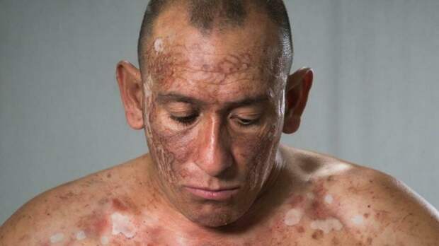 В Роспотребнадзоре назвали главный путь передачи оспы обезьян