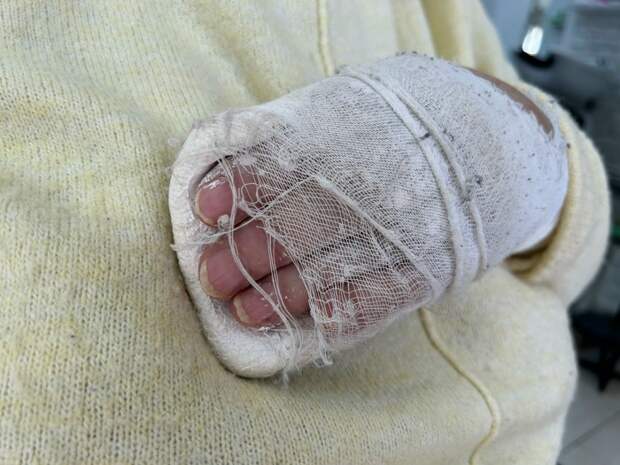 В Туле пенсионерка получила перелом руки из-за падения глыбы льда с крыши