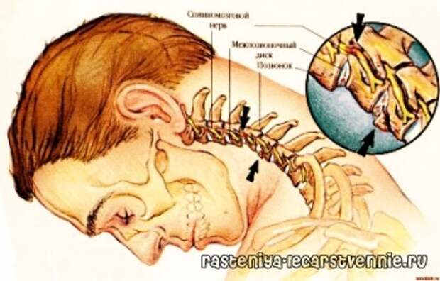 Шейный остеохондроз: о лечении народными средствами