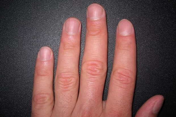 Mirror: по цвету ногтей можно узнать о проблемах с печенью и диабете