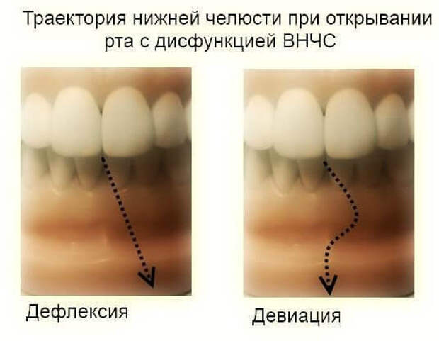 Лечение дисфункций височно-нижнечелюстного сустава