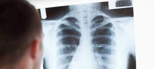 В Чехии активно распространяется туберкулез. Медики увязывают эпидемию с наплывом украинцев