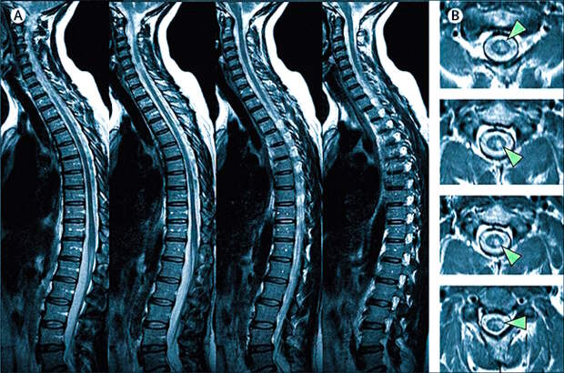 Показания к проведению магнитно-резонансной томографии (МРТ) позвоночника