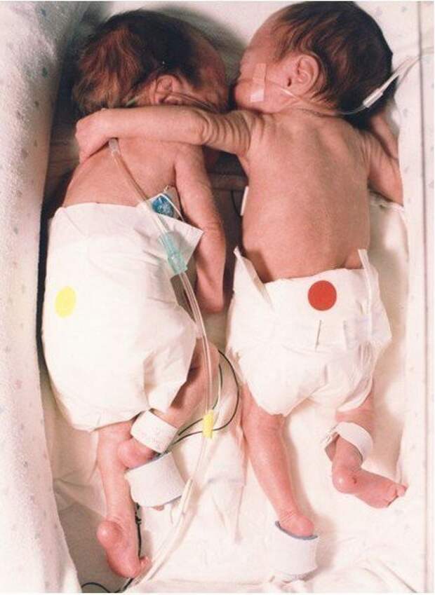 Эти близнецы, брат и сестра, родились раньше...