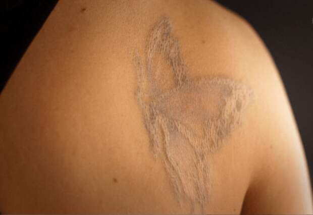 Татуировки на шрамах как отдельный вид искусства