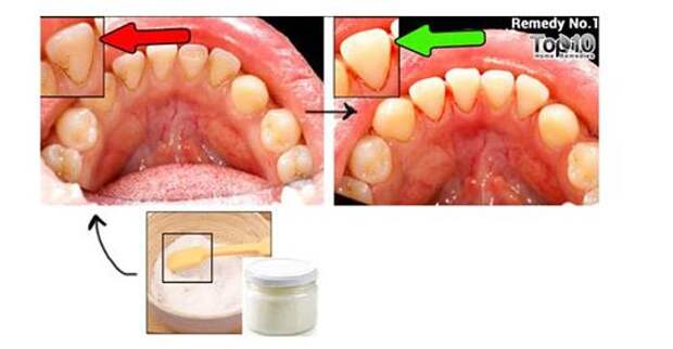Как естественным способом удалить зубной налет и зубной камень