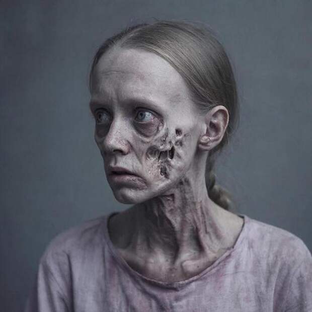 Психиатр рассказал, представители какого пола в десять раз чаще страдают анорексией