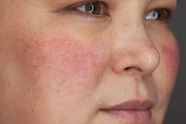 5 косметических проблем, с которыми нужно идти к врачу, а не к косметологу