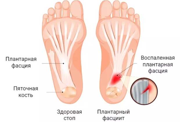 Разрыв плантарной фасции: симптомы, лечение и реабилитация