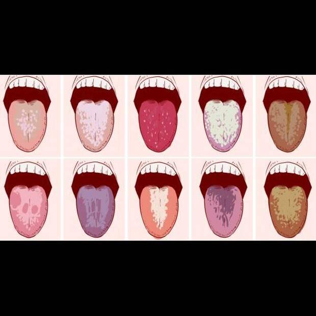 Что означает кровь во рту. Ралетна языке человека. Заболевания по цвету языка.