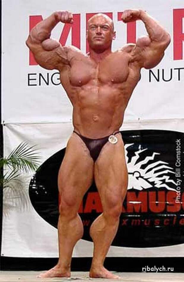 Synthol Buttock Injections