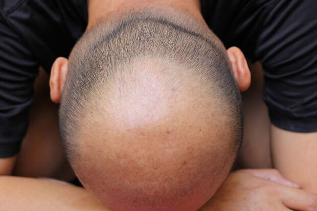 NatCom: шапка со светотерапией подавляет изменения волосяных фолликулов на 92%