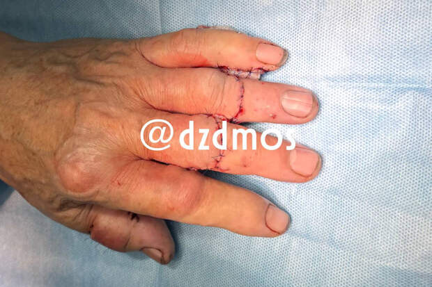 В Москве мужчине отрезало пальцы угловой шлифмашинкой