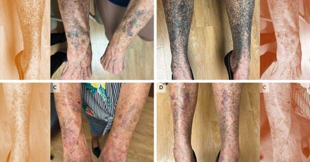 Потемнение кожи на руках и ногах пожилой американки объяснили действием миноциклина