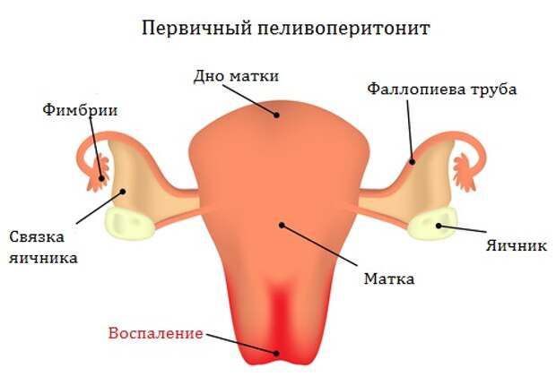 Пельвиоперитонит в гинекологии — причины, диагностика, лечение и симптомы