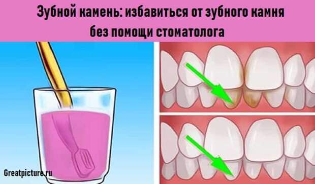 Зубной камень: избавиться от зубного камня без помощи стоматолога
