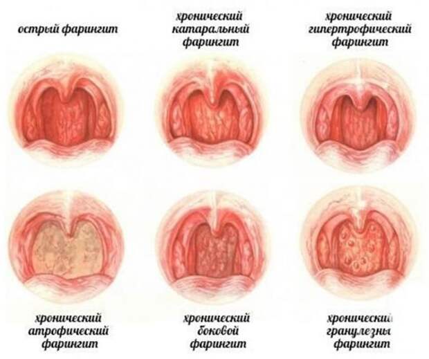 Лечение при фарингите: симптомы и причины заболевания, эффективное и быстрое лечение, советы медиков