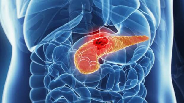 Искусственный интеллект точно ставит диагноз. Искусственный интеллект способен предсказывать рак поджелудочной железы за три года до его развития. Искусственный интеллект точно ставит диагноз. Искусственный интеллект способен предсказывать рак поджелудочной железы за три года до его развития. Фото.