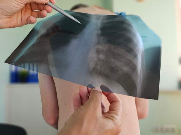 Распространенный вирус назвали фактором развития рака легких