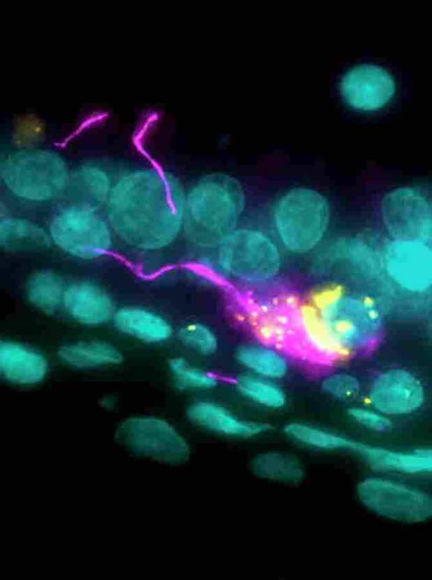 Нервная клетка (розовая), инфицированная коронавирусом SARS-CoV-2