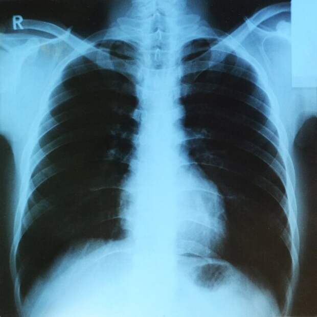 Рентгенограмма грудной клетки человека (прямая передняя проекция)