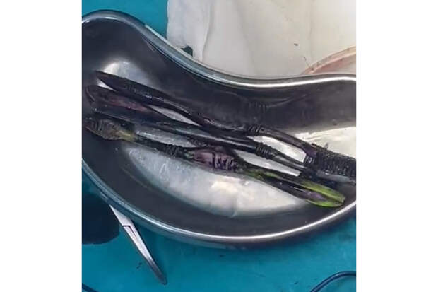 В животе мужчины нашли семь зубных щеток и два гаечных ключа