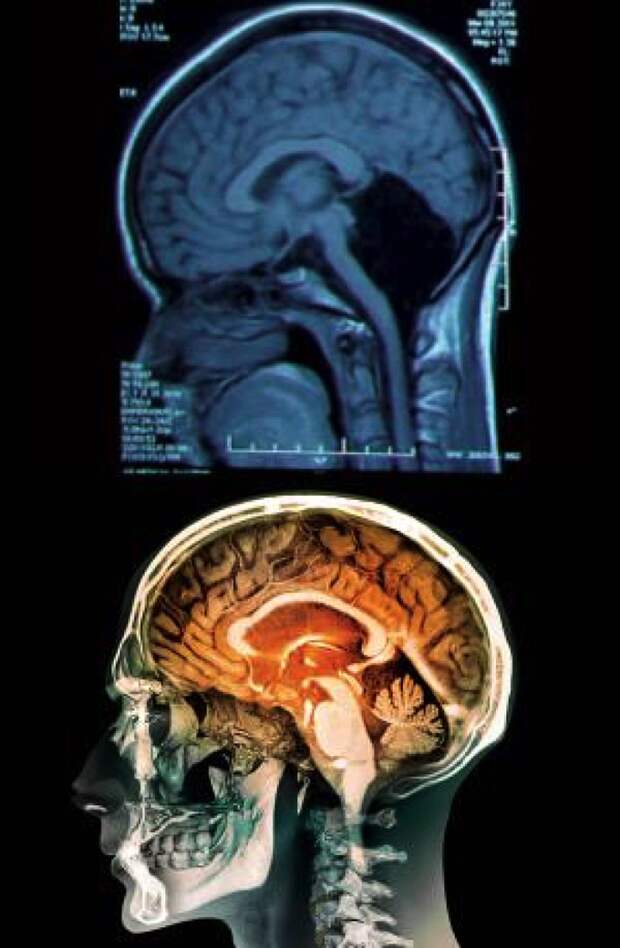 Женщина без мозжечка (вверху), внизу скан мозга с мозжечком. 