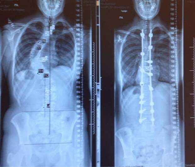 Рентгеновские снимки пациента до и после лечения сколиоза загадки, интересно, неизведанное, познавательно, тайны
