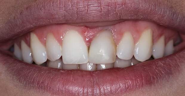 Потемнел зуб: причины, лечение и профилактика