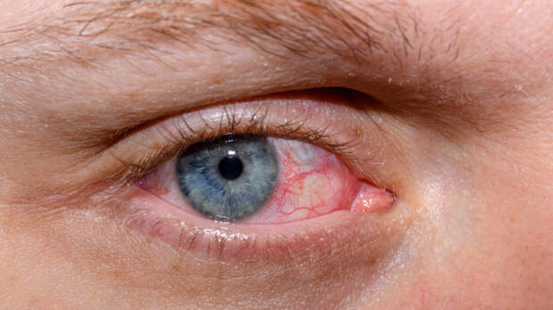 Офтальмолог Азнаурян назвал опасным самолечение покраснения глаз